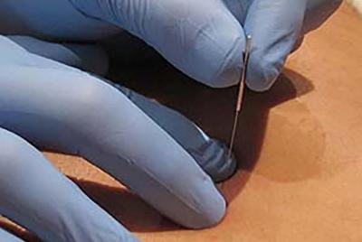 Terapia de aguja seca